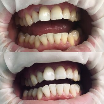 Професійне чищення зубів в «dental beauty clinic» в харкові. записатися акцією.