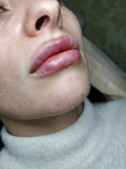 Lip augmentation in the studio of olena lysak in lviv. sign up for a contour correction for a promotion.