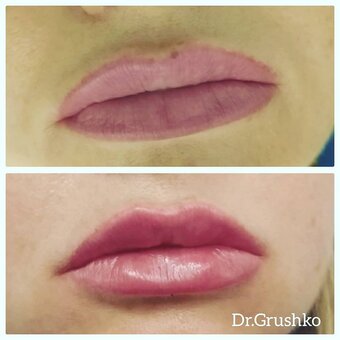 Lip correction in the cosmetology studio of Lyudmila Grushko. Sign up for a discount