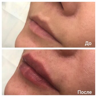 Lip filler in the cosmetology studio of Lyudmila Grushko. Sign up for a discount