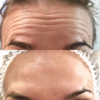 Косметологічний кабінет Олени кузьменко в Києві. прибрати зморшки, знижки.