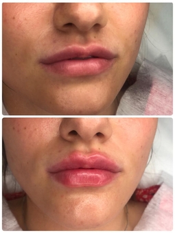 Косметолог Олена Кузьменко в києві. знижки на пластику губ.