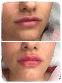 Косметолог Олена Кузьменко в Києві. спеціальні пропозиції на пластику губ.