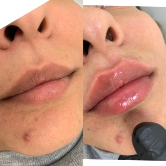 Косметолог Олена Кузьменко в Києві. контурна пластика губ, акції.