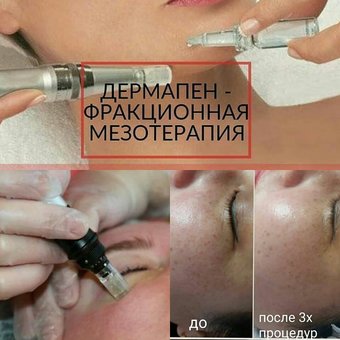 Мікронідлінг (дермапен) - відмінна альтернатива ін'єкційної біоревіталізації і мезотерапії